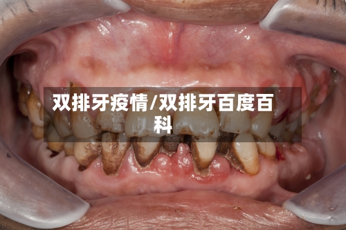双排牙疫情/双排牙百度百科